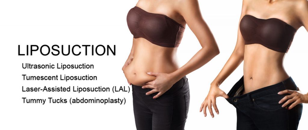 Liposuction in Mexico