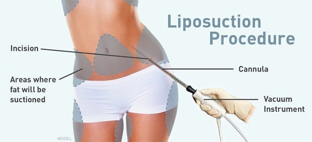 4 Things You Should Know about Liposuction