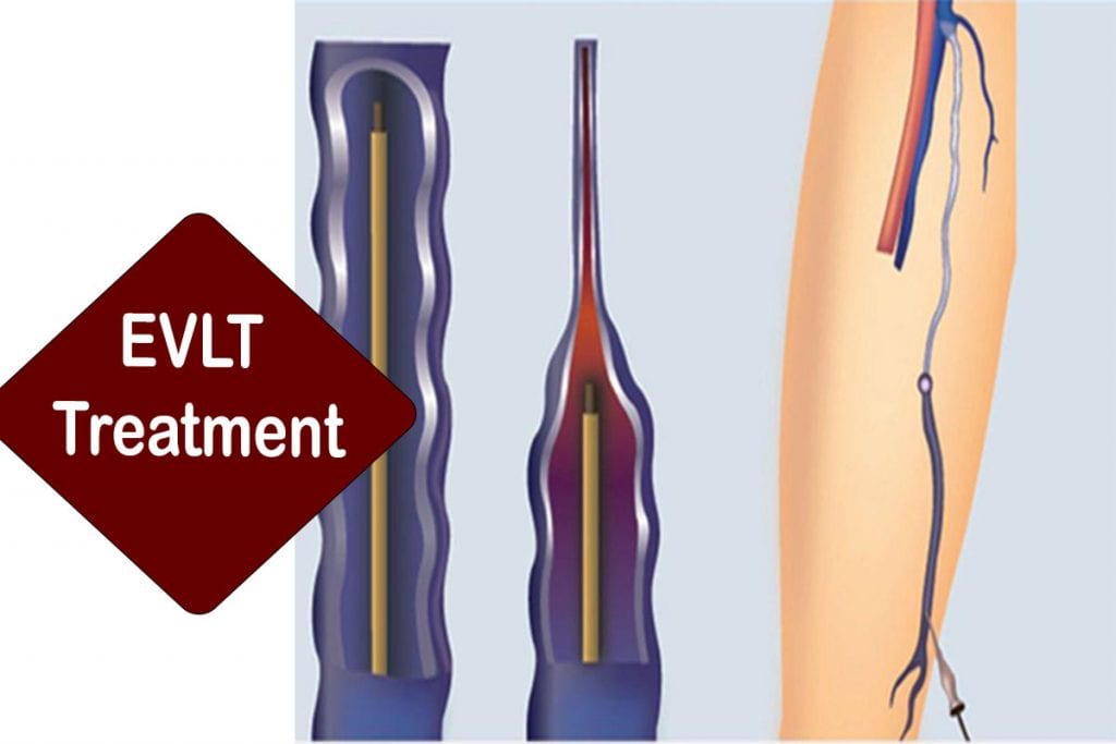 evlt treatment