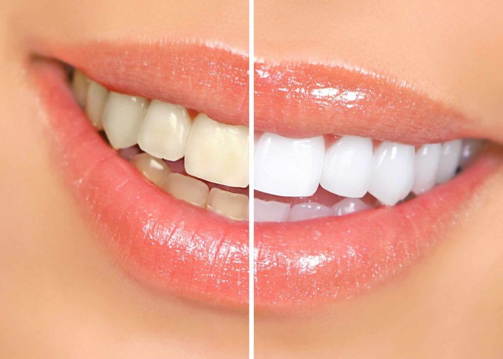 teeth whitening cost