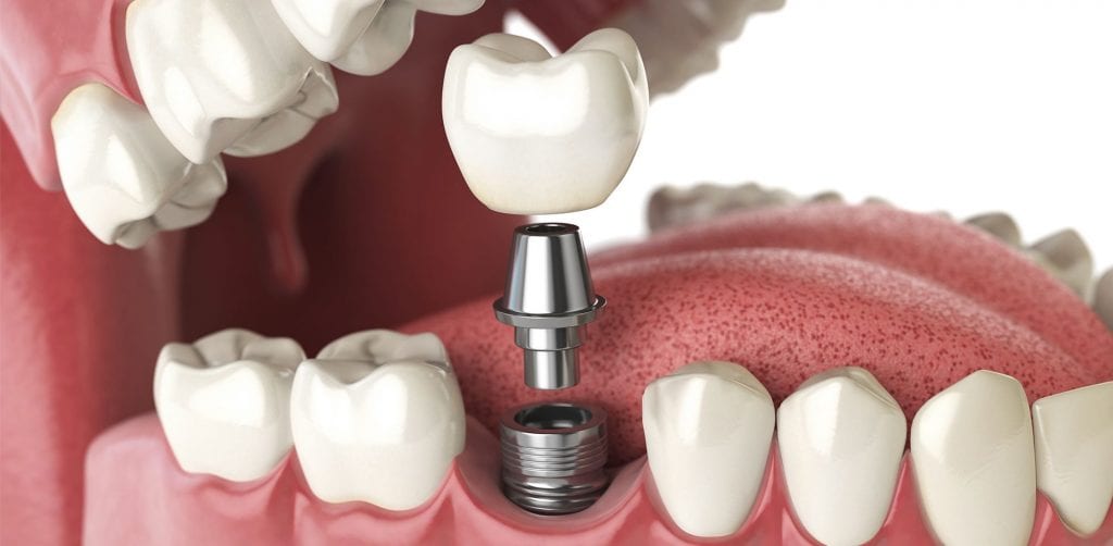 Benefits of All-on-4 Dental Implants in Turkey