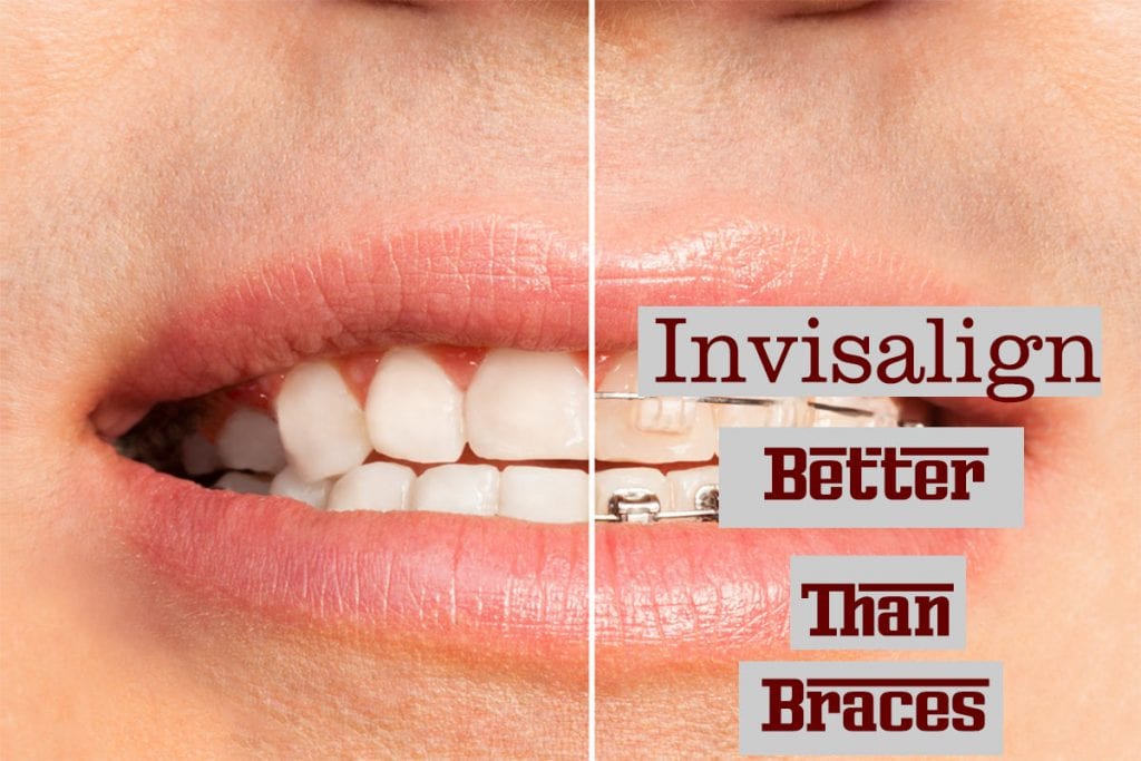 invisalign