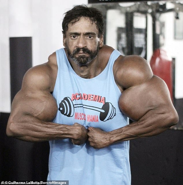 Brazilian bodybuilder synthol injection
