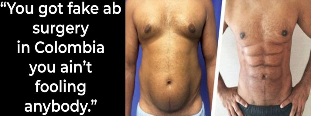 Fake Ab Surgery