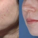 Scar Removal Pros and Cons