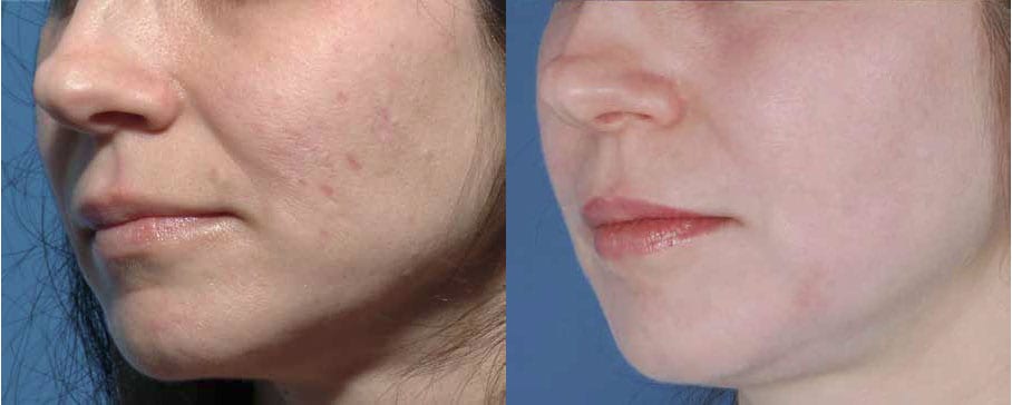 Scar Removal Pros and Cons