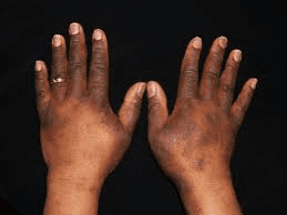 Symptoms of Eczema
