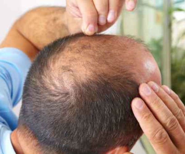 Can Wearing a hat caused balding?