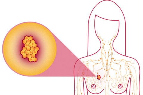 Morning People - Breast Cancer Free