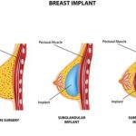 Top 6 Herbs for Natural Breast Enhancement 1