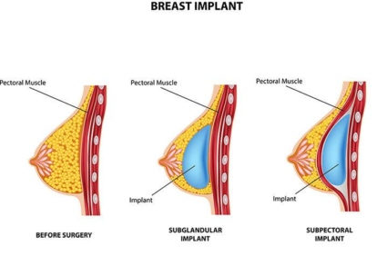 Top 6 Herbs for Natural Breast Enhancement 1