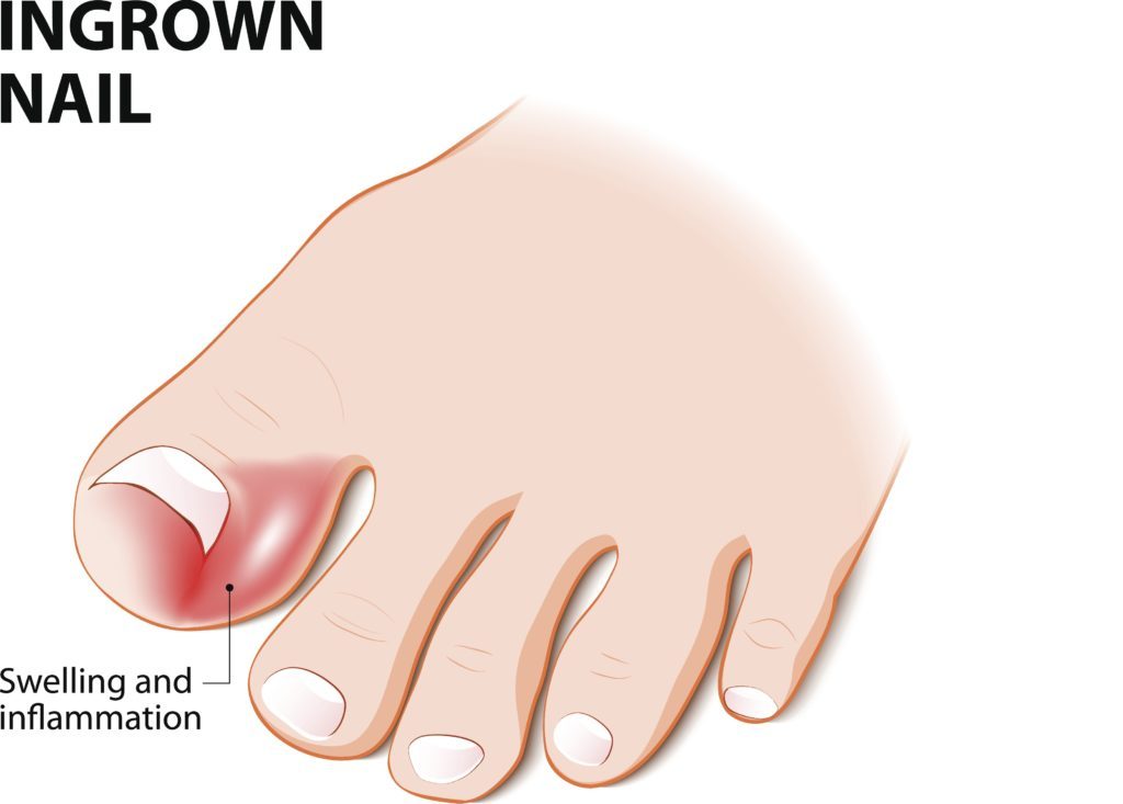 Ingrown nail