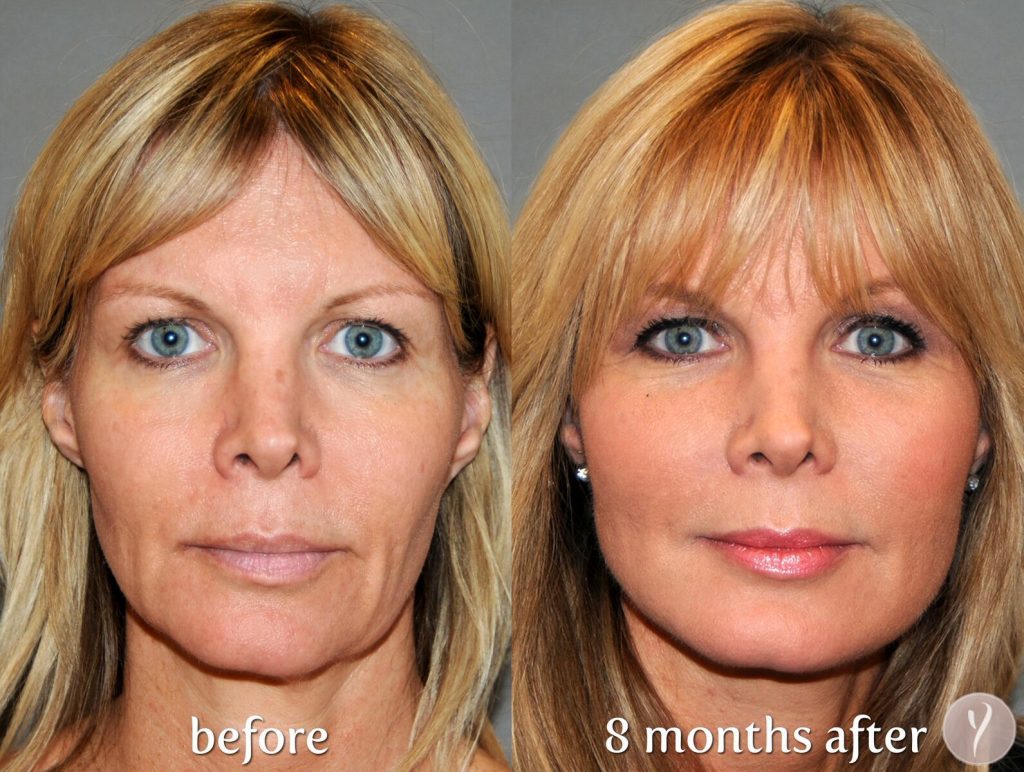 face lift Before and After