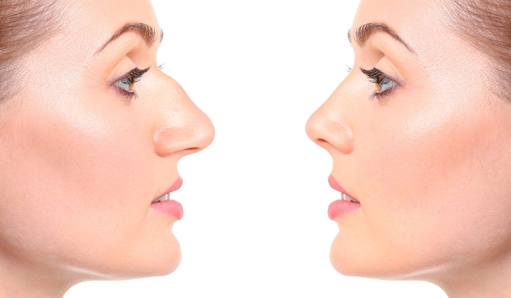 rhinoplasty procedure