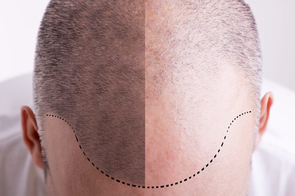 Hair Replacement