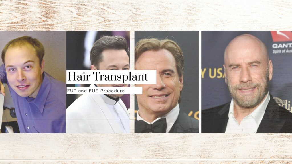 Hair Transplant Timeline - Collage Photo