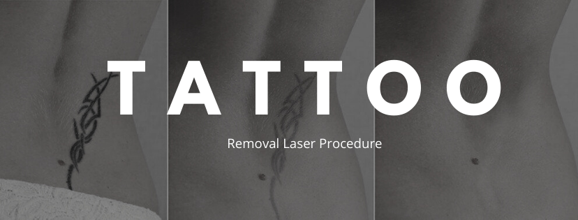 How To Choose The Right Laser Tattoo Removal Clinic 1 tattoo removal laser procedure