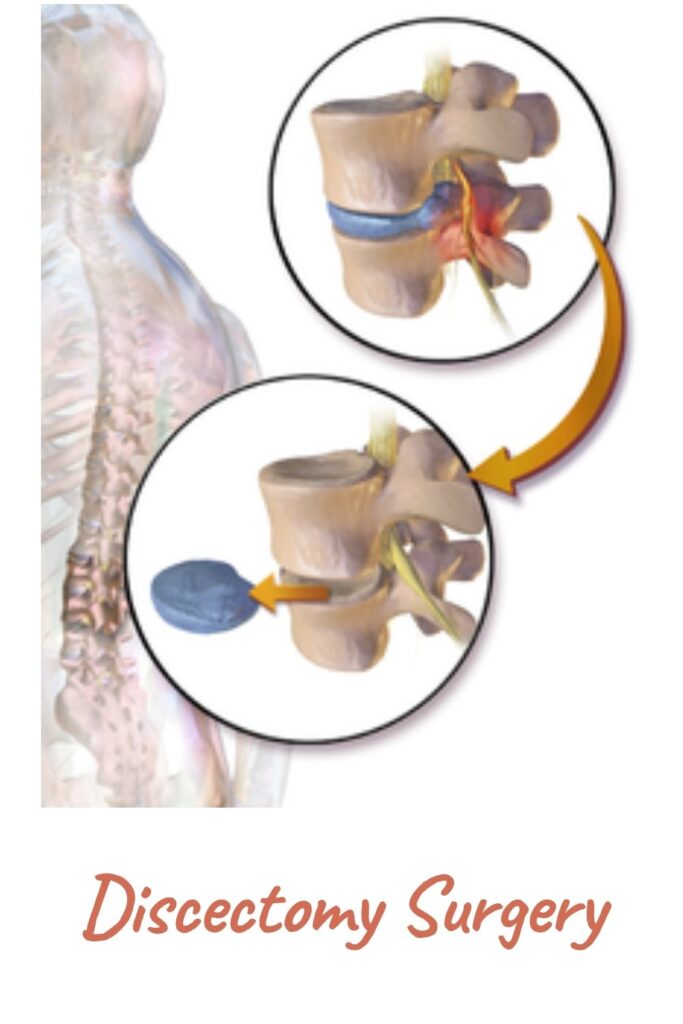 showing what is Discectomy Surgery - Discectomy Surgery