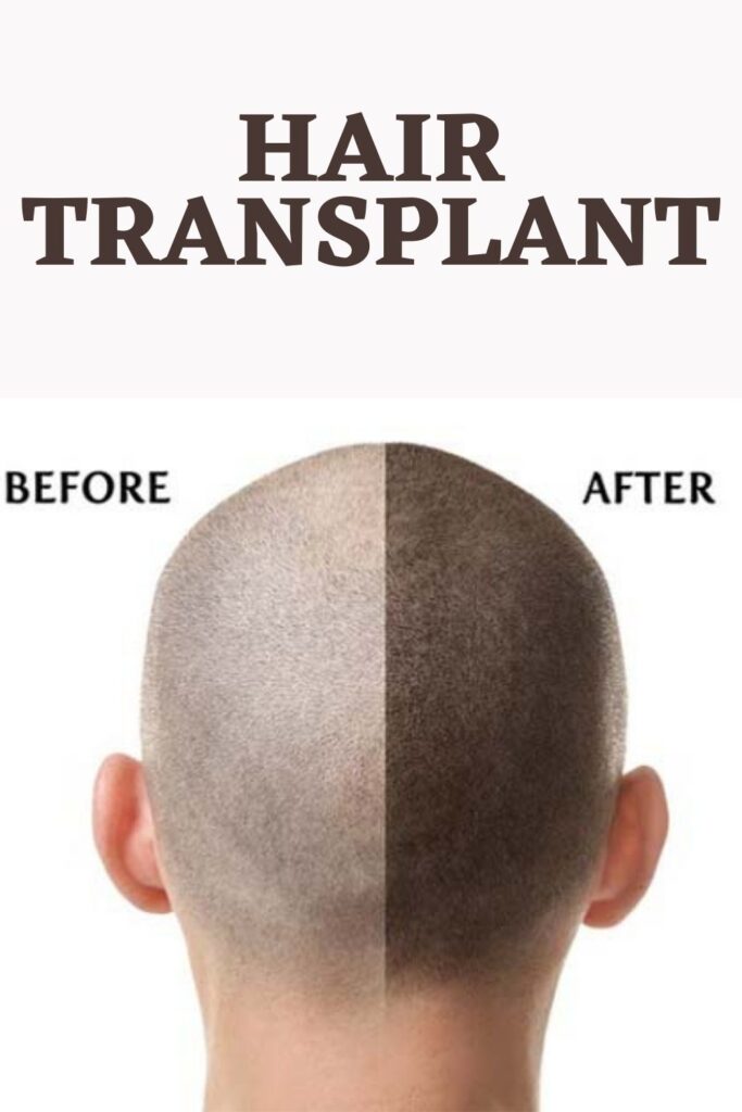 Before and after effects of Hair transplants in Turkey - hair transplants Turkey