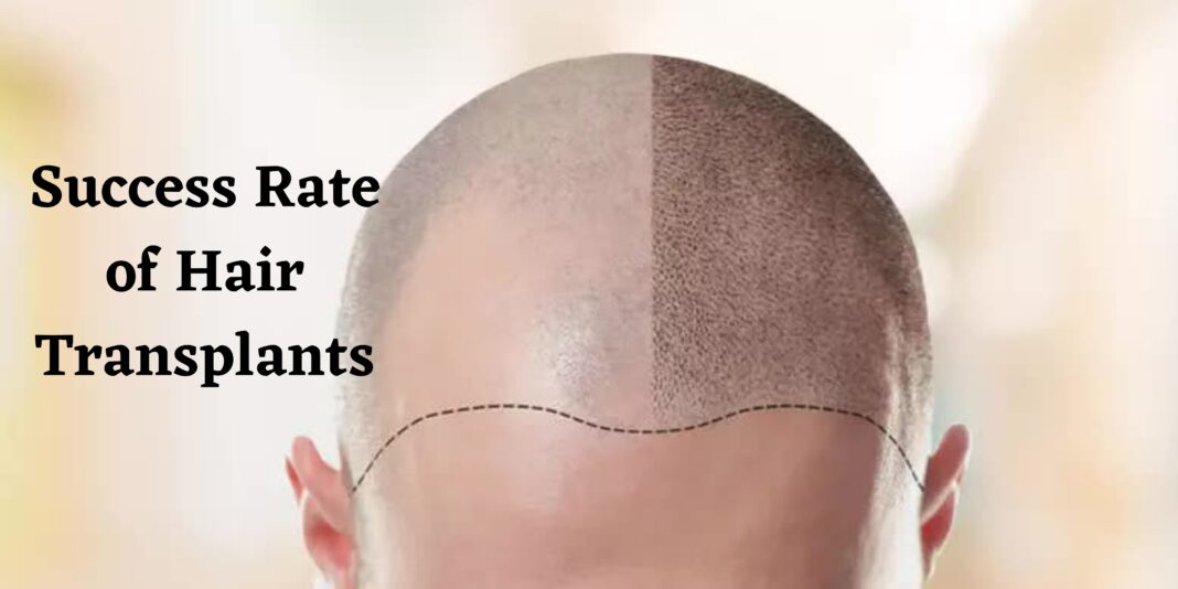 success rate of hair transplants