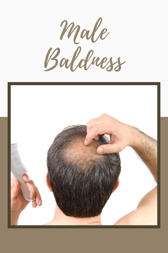 A man is showing his baldness - male baldness