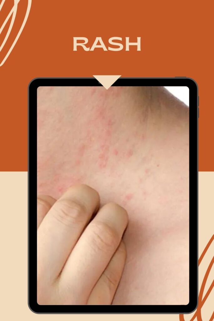 Some one is showing rash on the skin - Skin Blemishes meaning