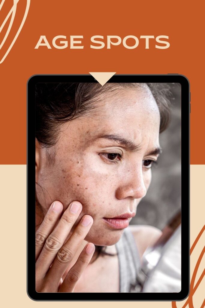 A lady is showing age spots on her face - Skin Blemishes types