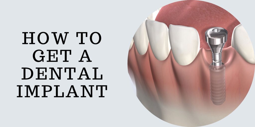 Why Should You Get A Dental Implant & How To Get It?