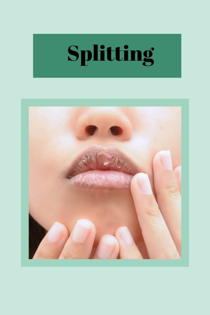 A girl is showing her splitting lips -  lip care tips