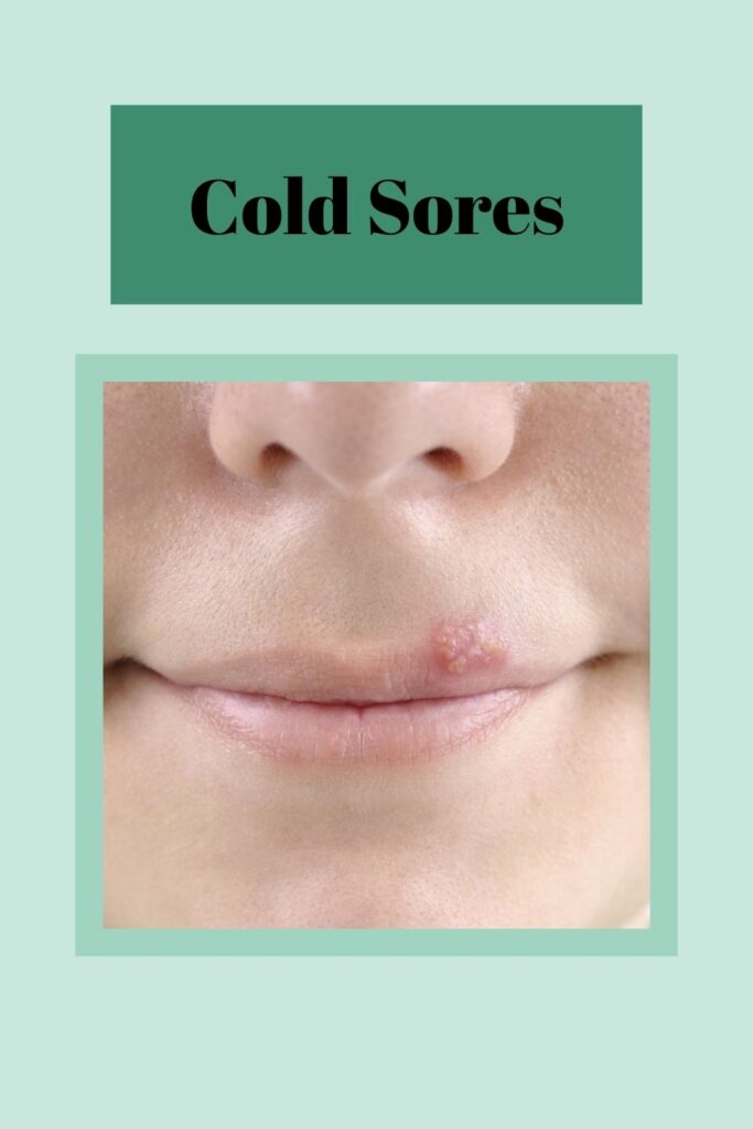 A women is showing cold sores on her lips -  lip care home remedies