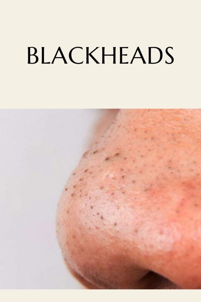 Someone is showing his blackheads - remove pimples