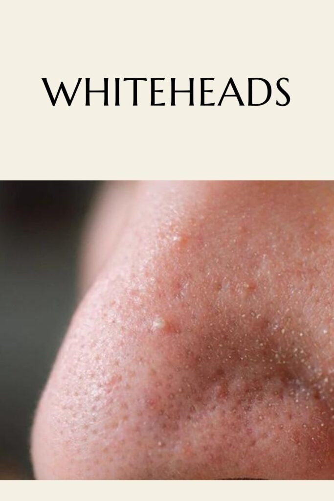 Someone his showing his whiteheads Someone his showing his whiteheads - remove pimple tips