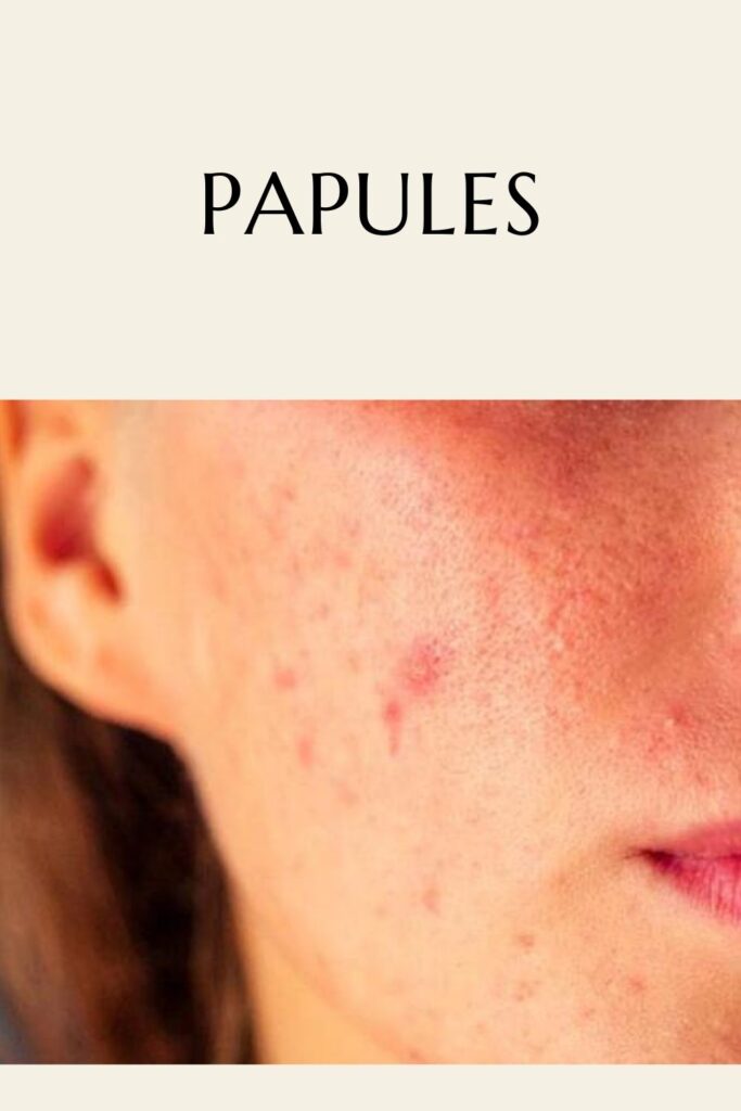 A girl is showing her Papules acne on her face - skincare routine for acne prone skin