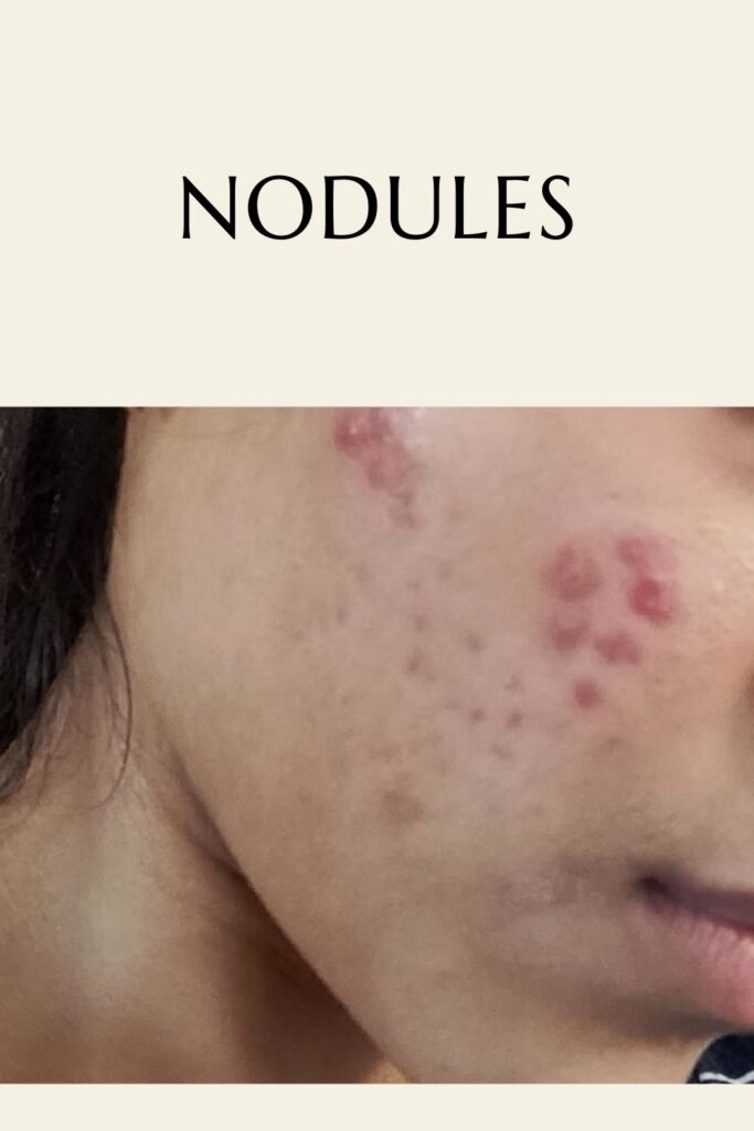 A girl is showing her nodules pimples - remove skin blemishes