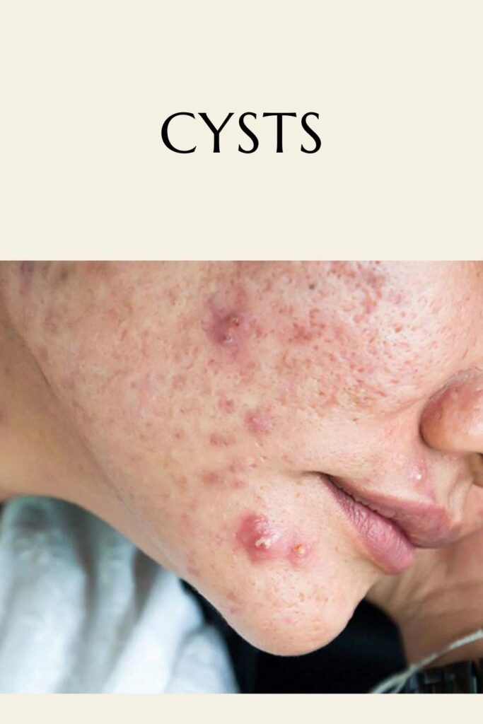 A girl is showing her cysts on her face A girl is showing her cysts on her face - pigmentation
