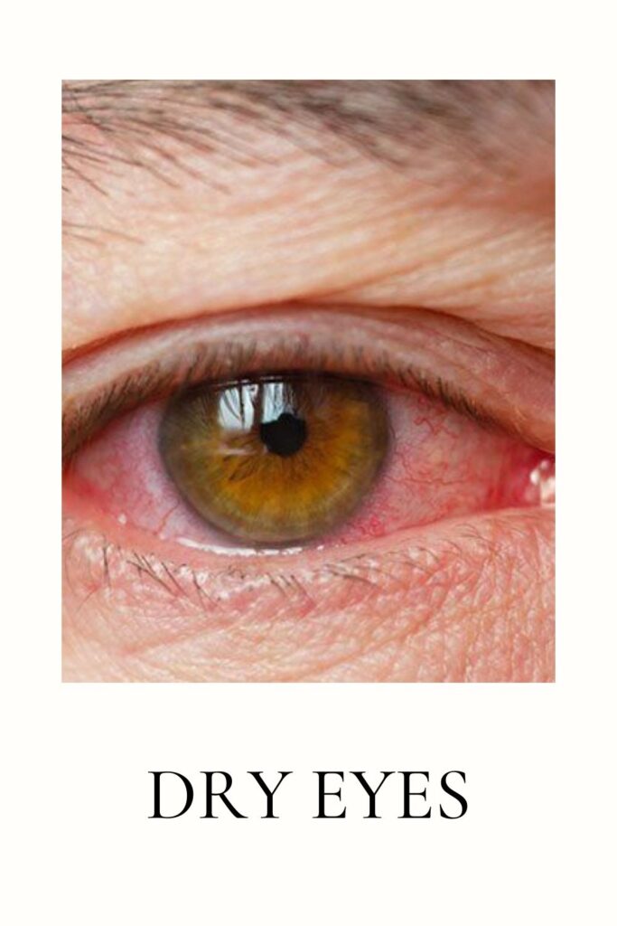 A red dry eye is shown in image A red dry eye is shown in image - dry eyes