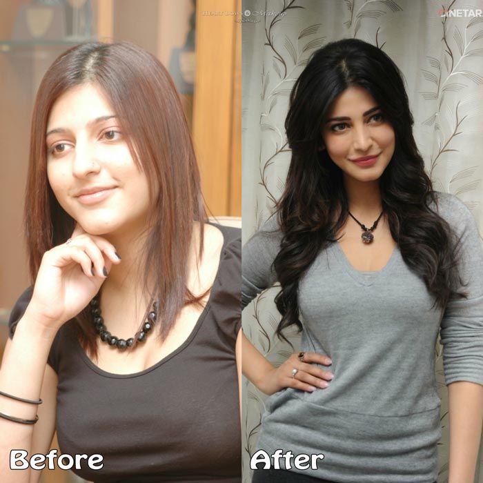 Shruti Haasan before and after pics of cosmetic surgery - bollywood cosmetic surgery revealed