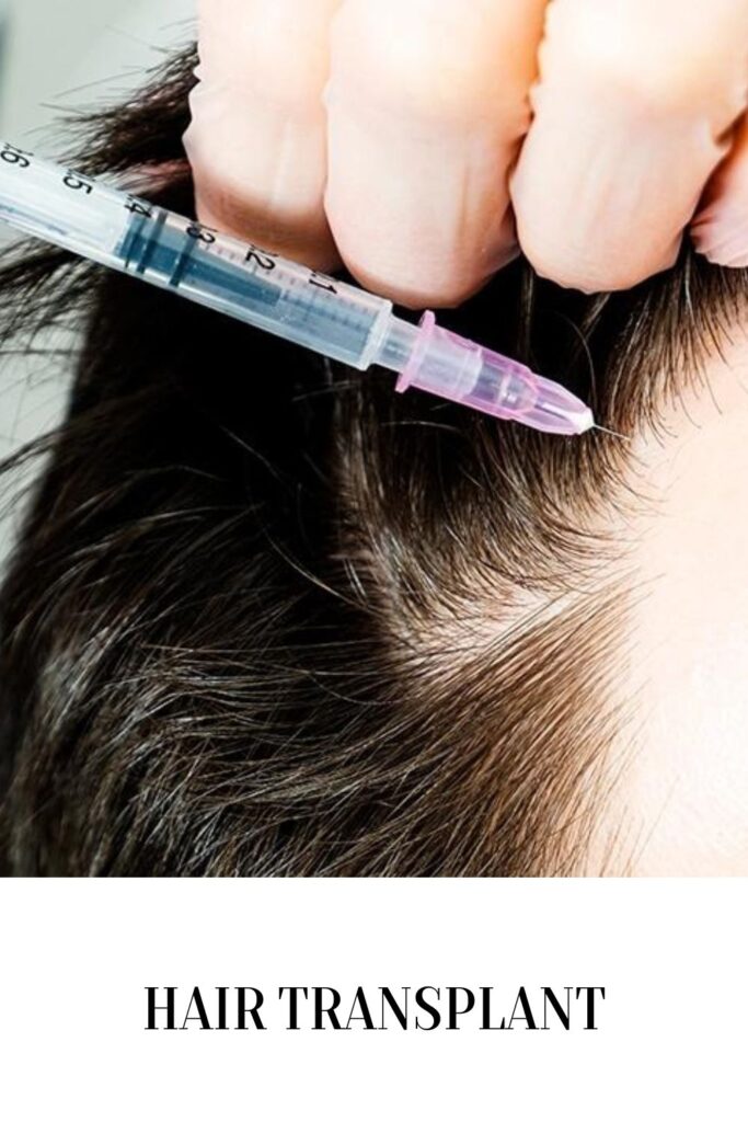 A doctor is giving an injection in head for hair transplant procedure - hair transplant