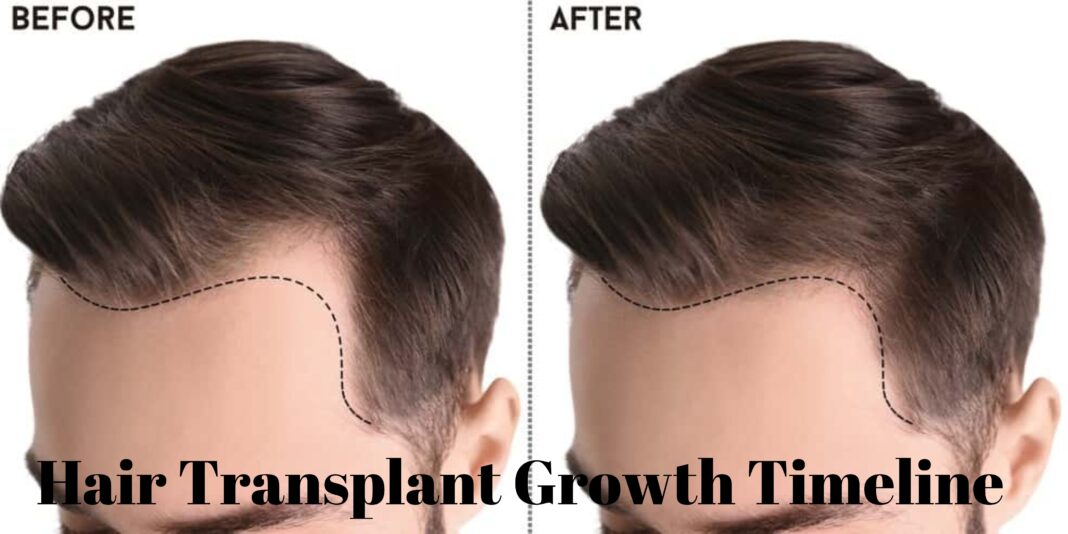Hair Transplant Growth Timeline