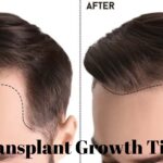 Hair Transplant Growth Timeline