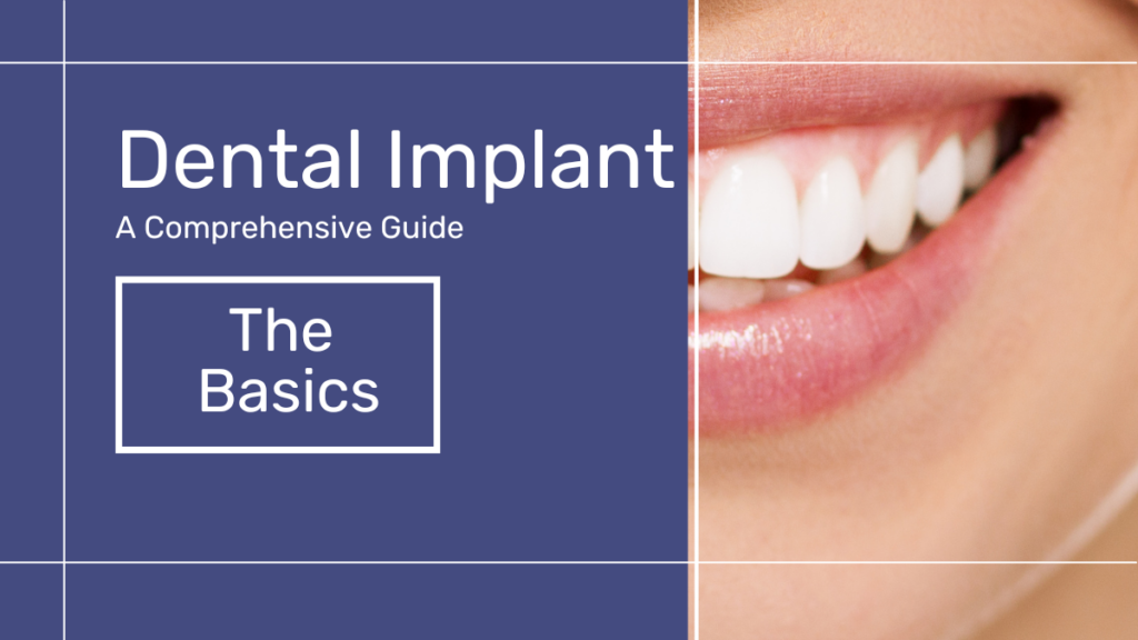 A Comprehensive Guide to All-on-4 Dental Implant
