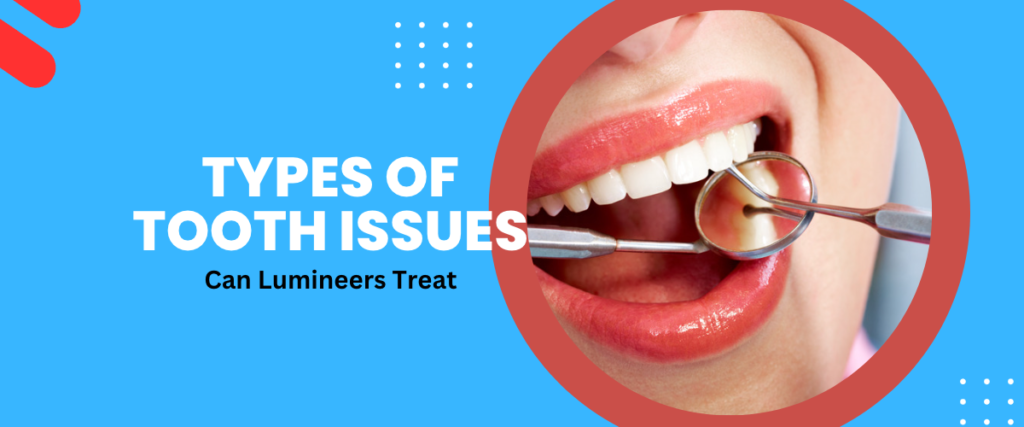 What Types of Tooth Issues Can Lumineers Treat?